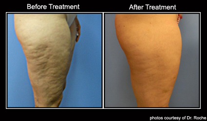 Cellulite Removal - Tal Redcar