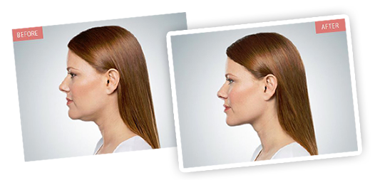 Kybella - Before and After