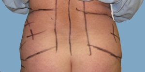 Before - Patient# 67152-Irene G. Before
