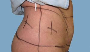 Before - Patient# 67152-Irene G. Before