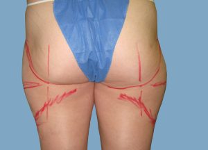 Before - Patient# 67153-Tess O. Before