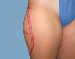 Before - Patient# 67153-Tess O. Before