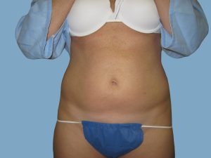 Before - Patient# 67189 – Francine A. Before