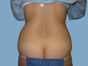 Before - Patient# 67189 – Francine A. Before
