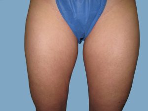 Before - Patient# 67189 – Francine A. Before