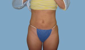 After - Patient# 67189 – Francine A. After