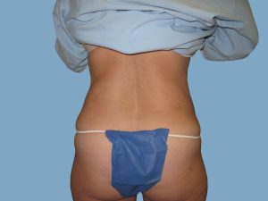 After - Patient# 67189 – Francine A. After