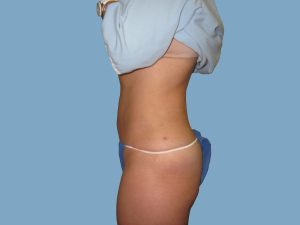 After - Patient# 67189 – Francine A. After