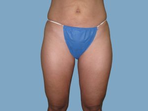 After - Patient# 67189 – Francine A. After